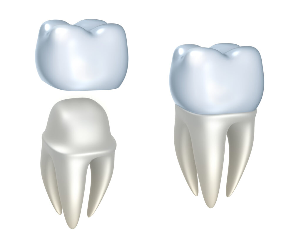 Dental Crown Vista