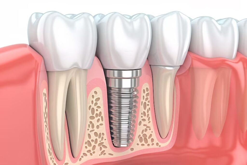 Dental Implants Carlsbad