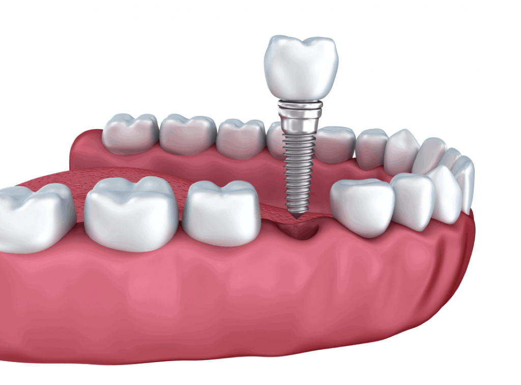 Dental Implants Near Me Vista