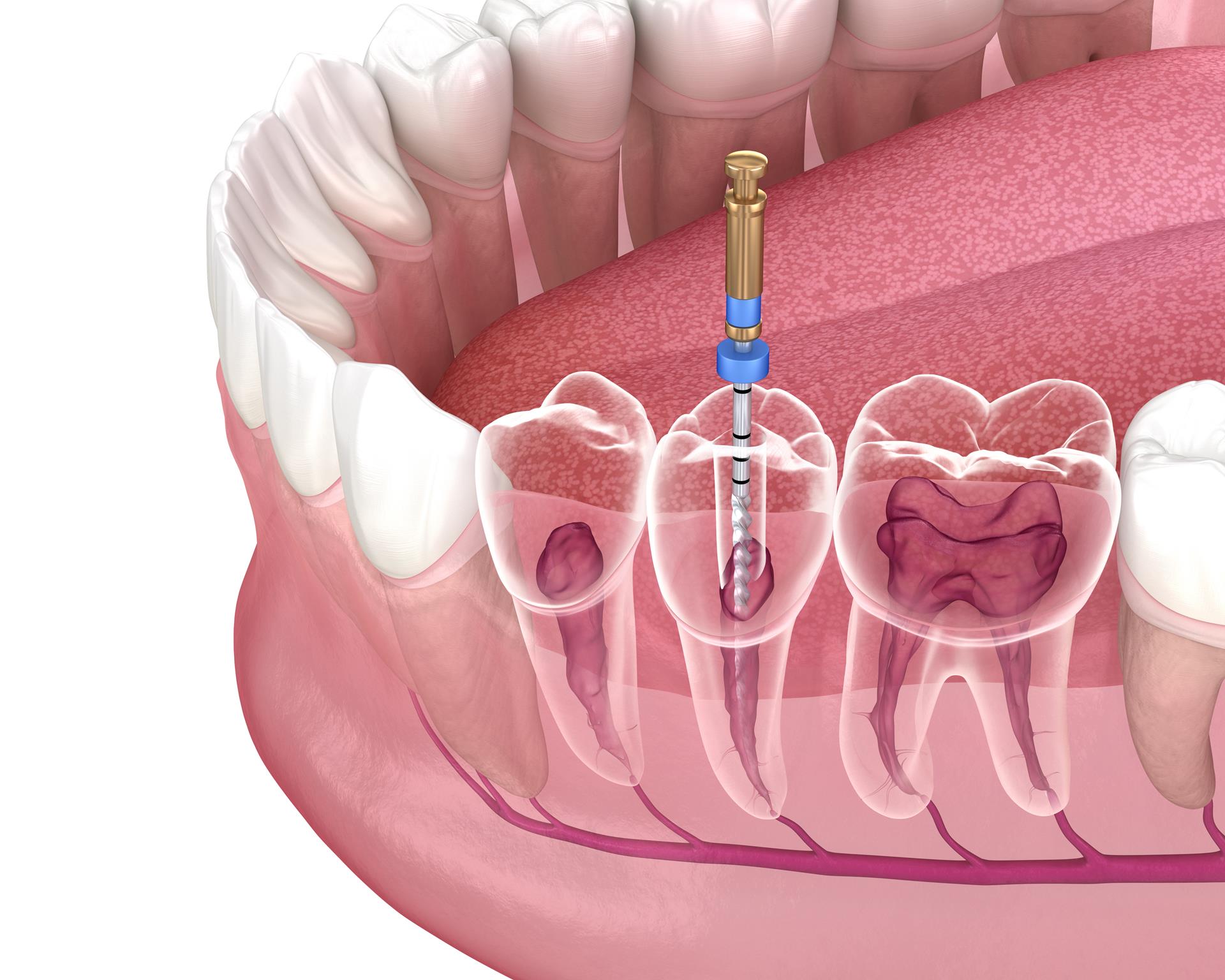 Vista Endodontist