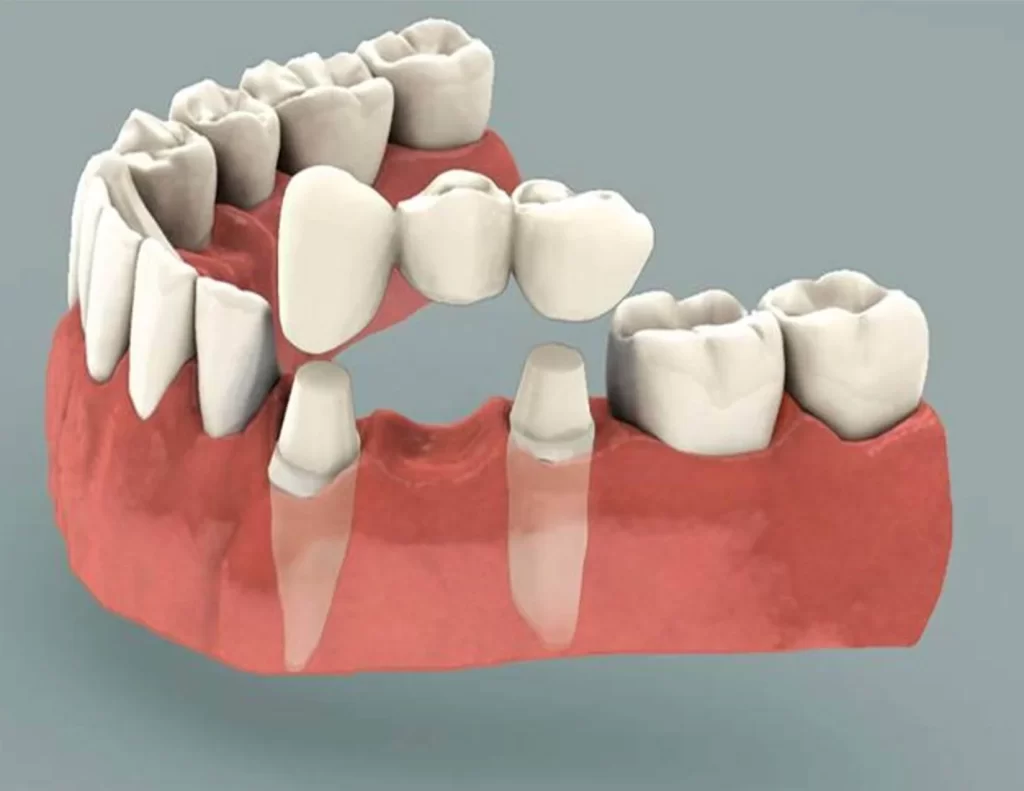 Dental Bridge Oceanside