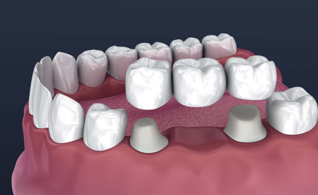 Dental Bridge Vista