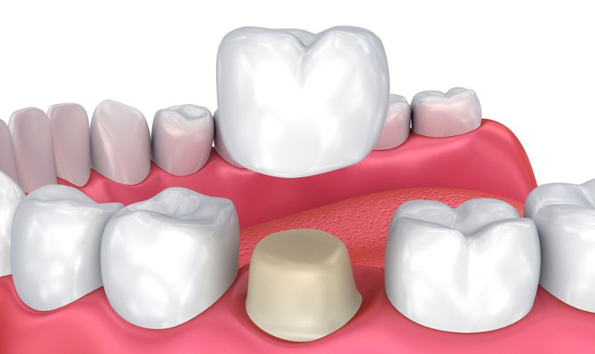 Oceanside Dental Crown
