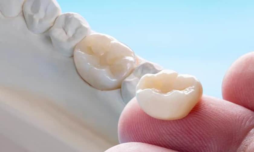 Dental Crown Vista