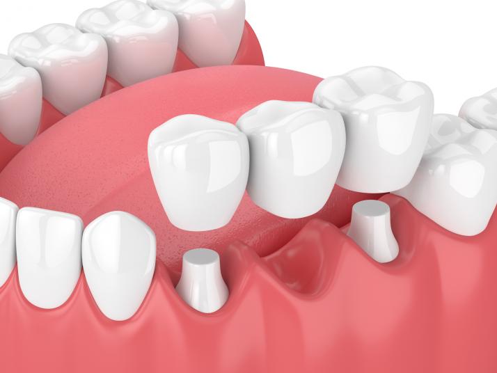 Oceanside Dental Bridge