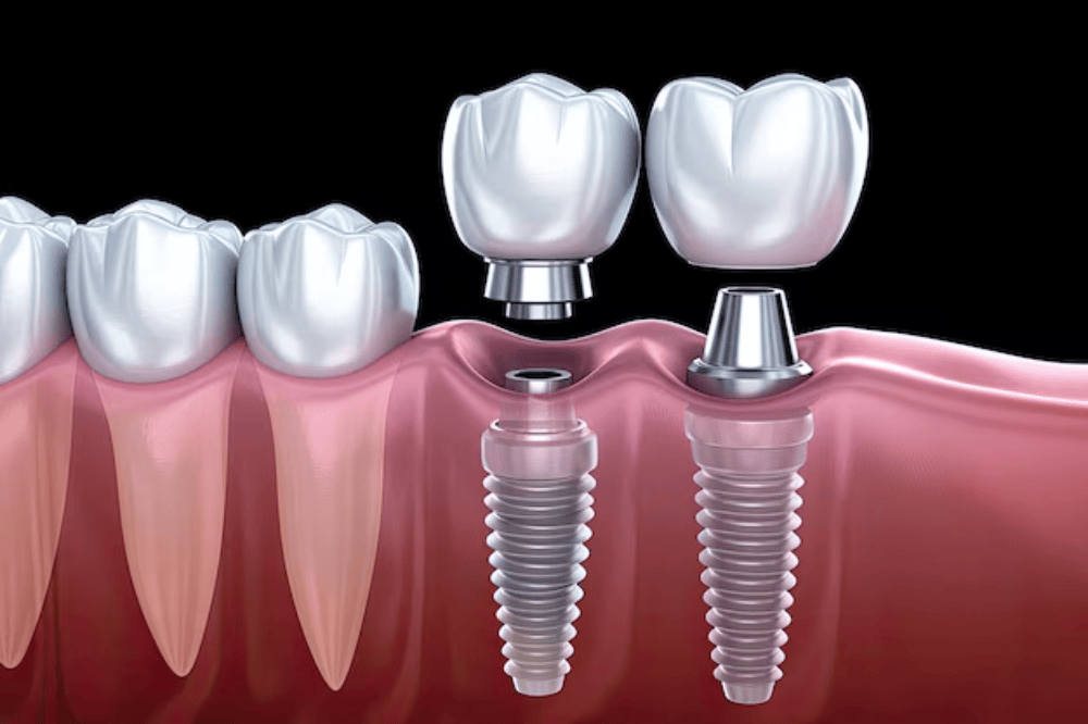 Dental Implant Cost Vista