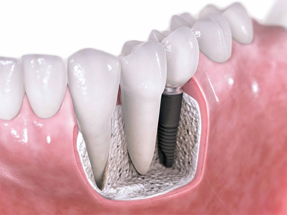Dental Implants Near Me Vista