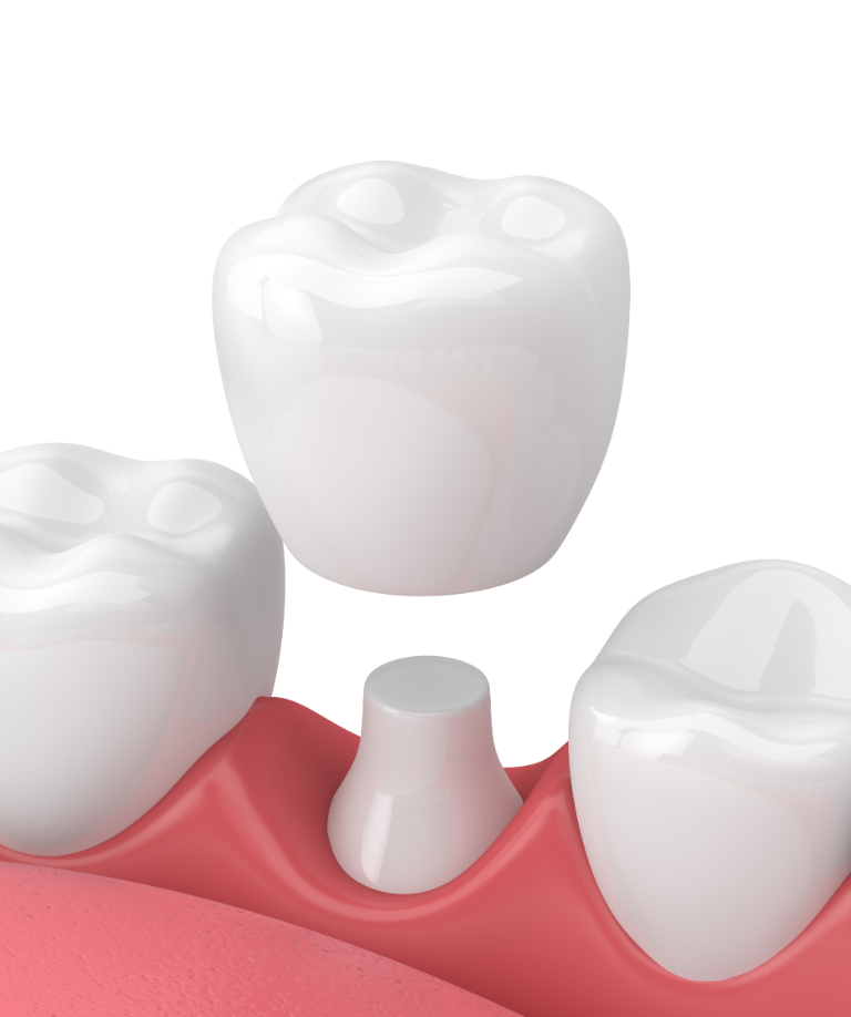 Vista Dental Crown