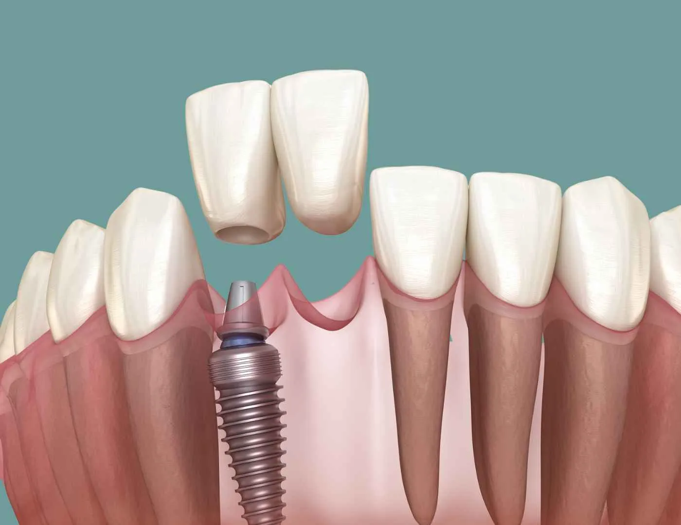Dental Implants Near Me Oceanside