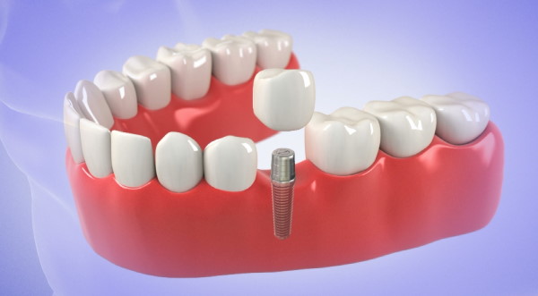 Dental Implant Cost Oceanside