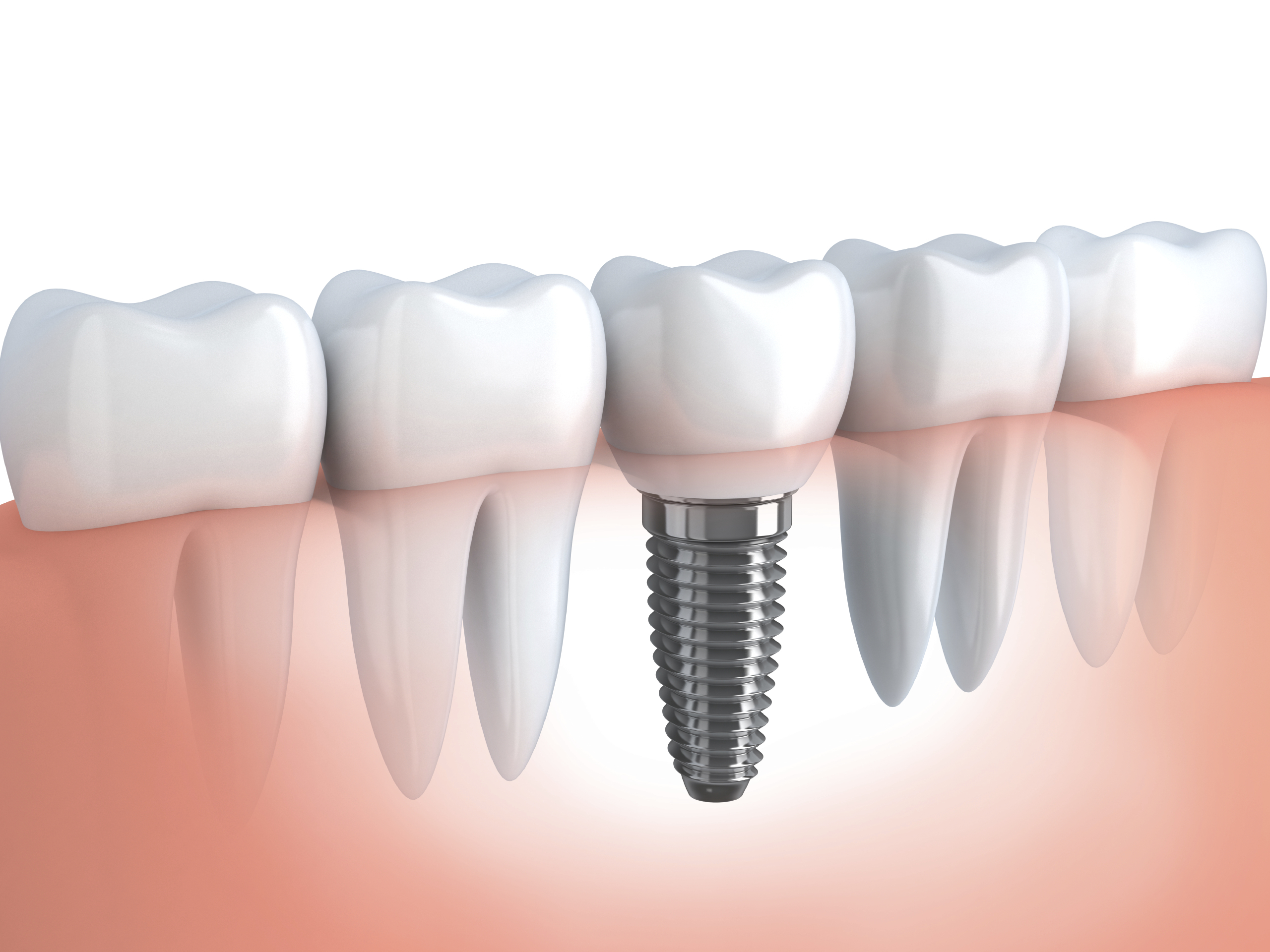 Oceanside Dental Implants