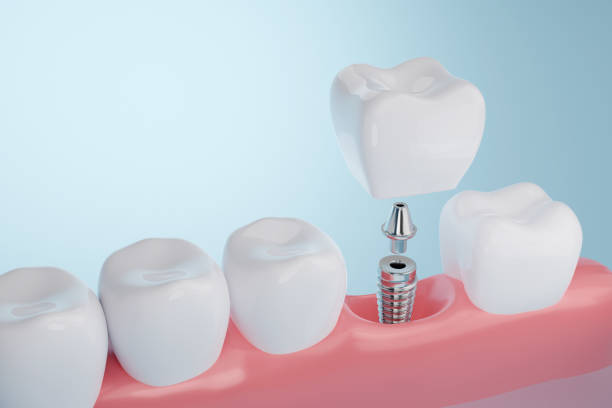 Dental Implants Near Me Oceanside