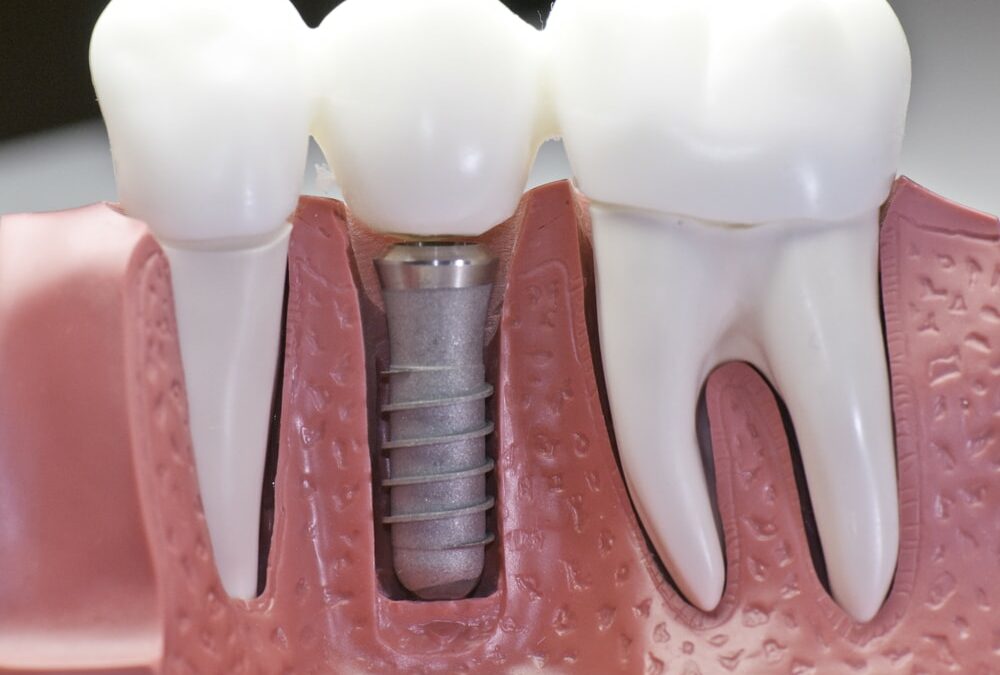 Dental Implants Vista