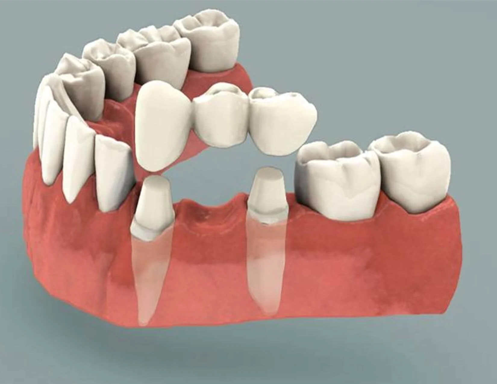 Dental Bridge Vista