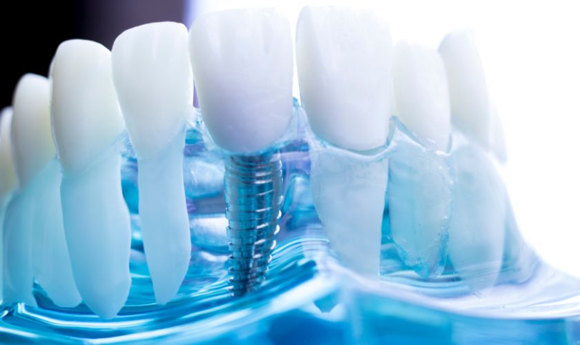 Dental Implant Cost Vista