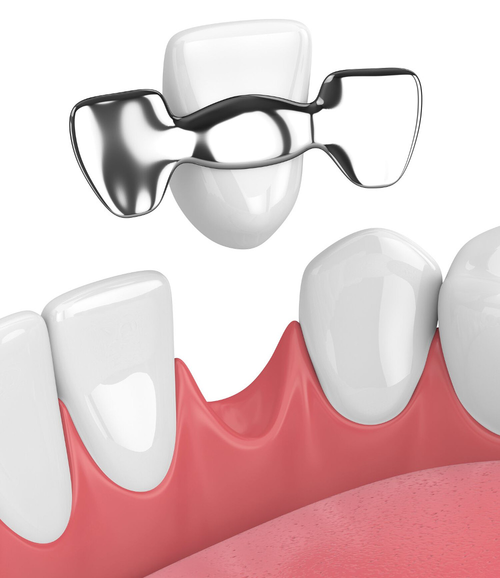 Dental Bridge Carlsbad