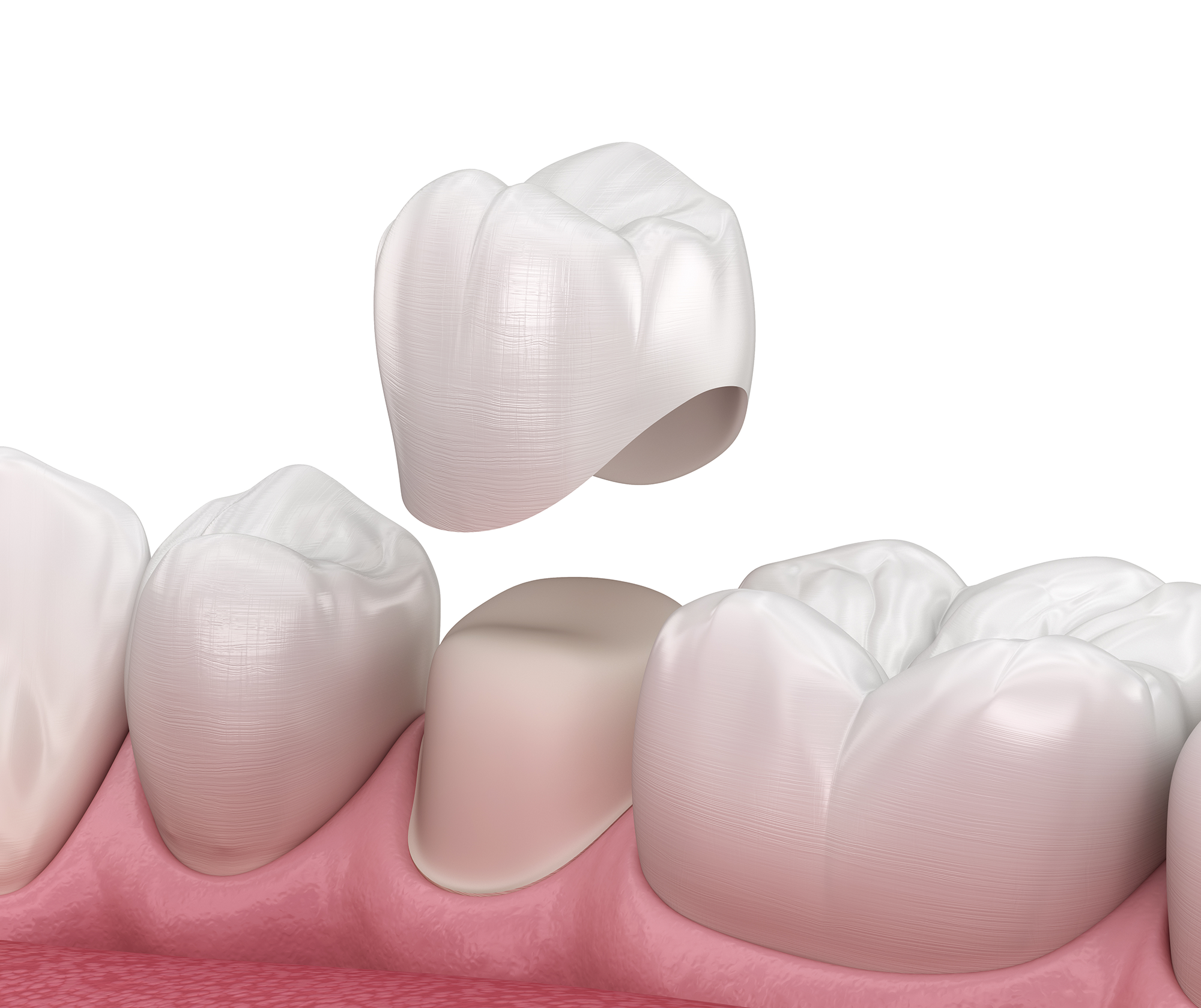 Dental Crown Vista