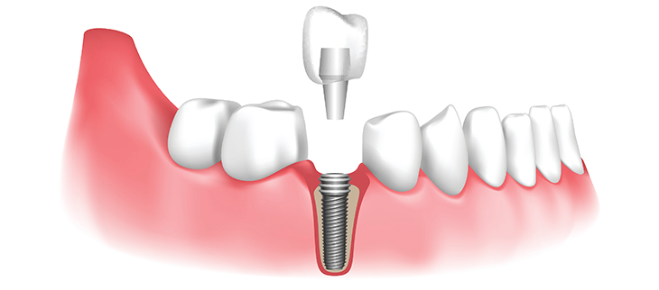 Dental Implant Cost Vista