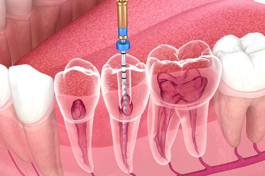 Oceanside Endodontist