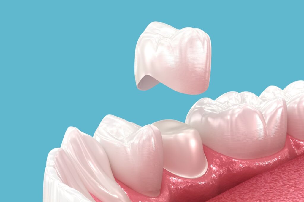 Dental Crown Oceanside