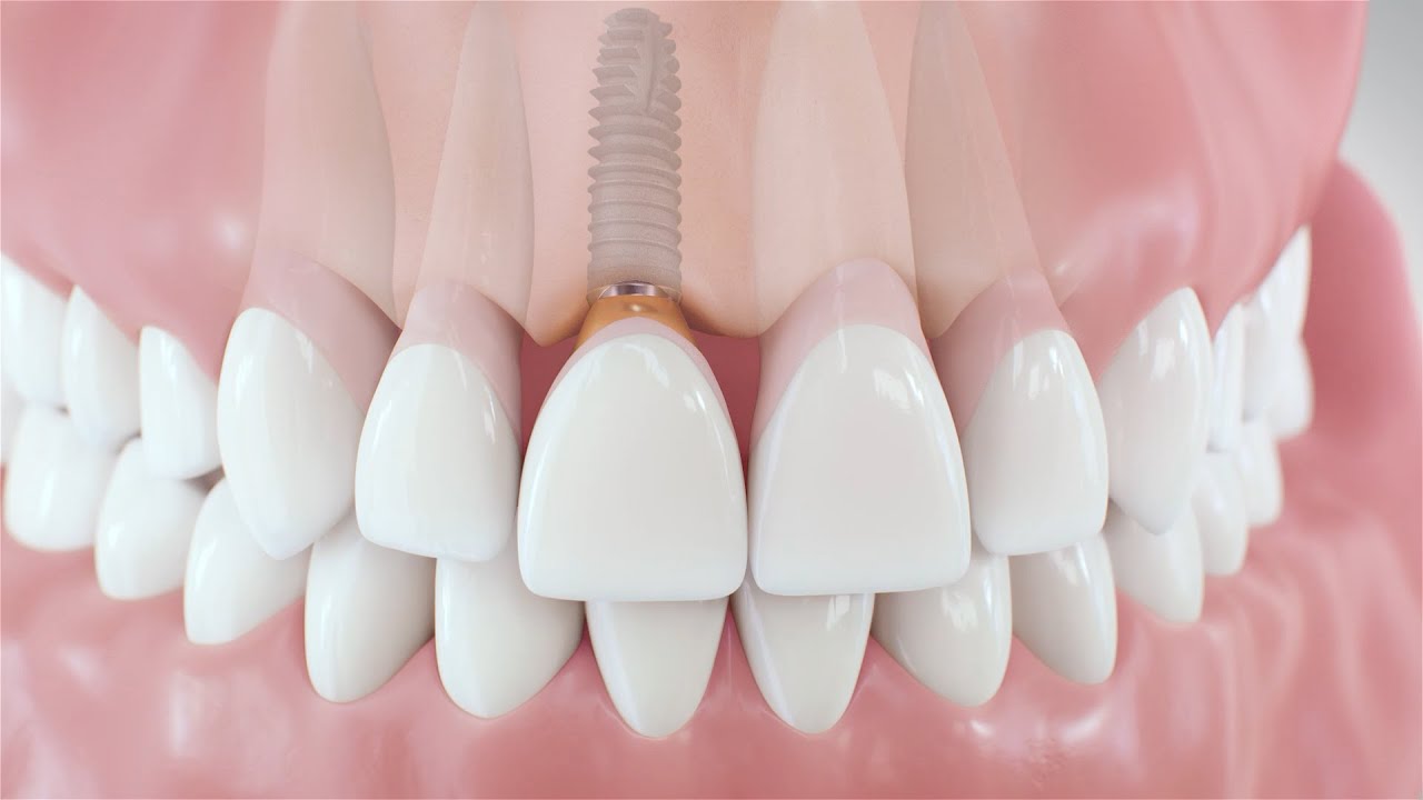 Dental Implants Carlsbad