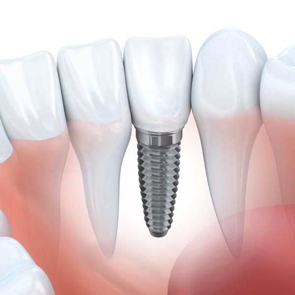 Dental Implants Oceanside