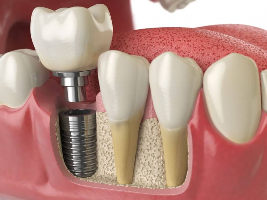 Dental Implant Cost Vista