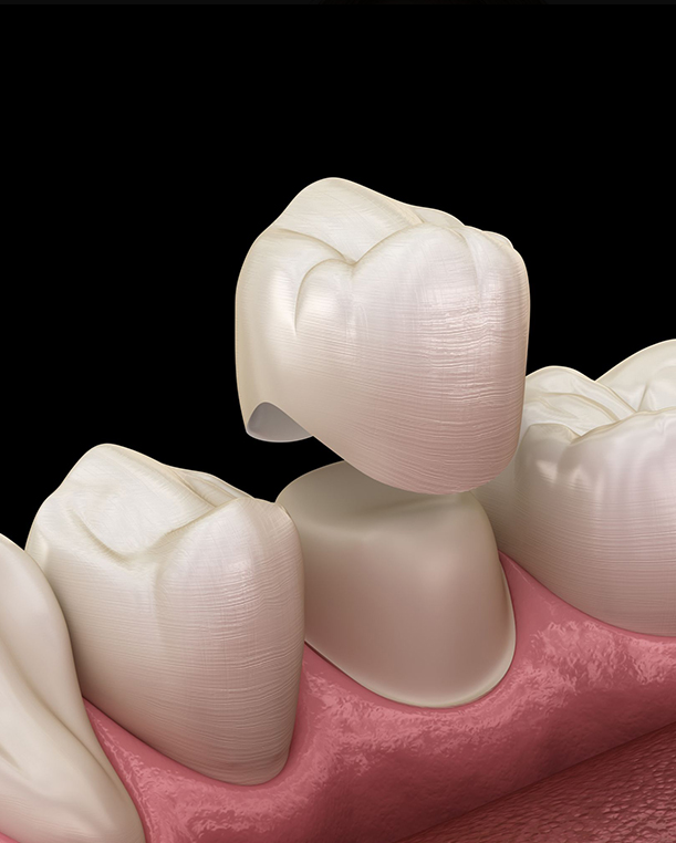 Vista Dental Crown