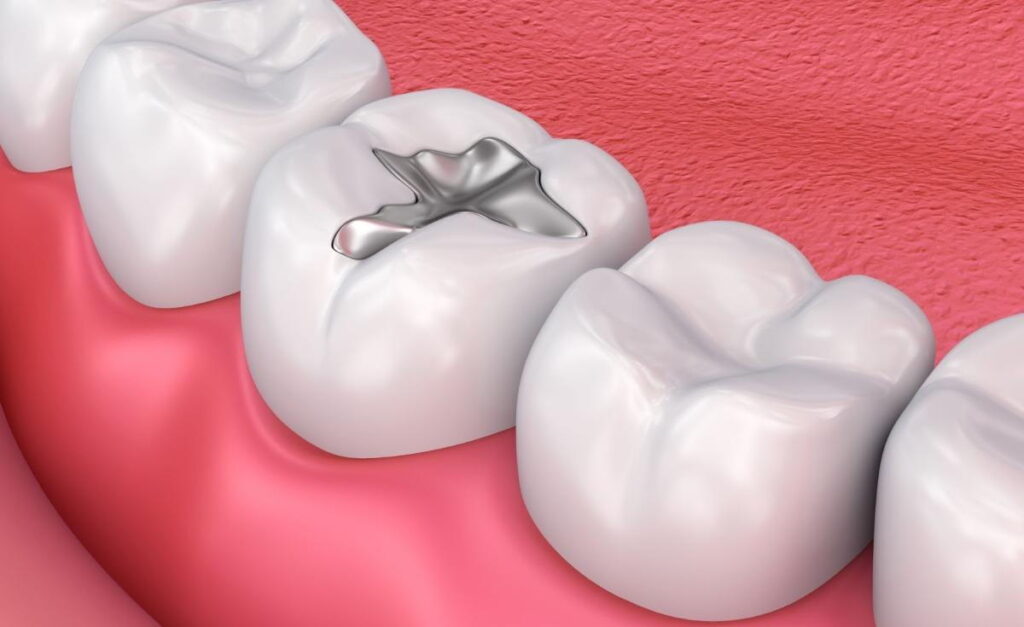 Tooth Filling Carlsbad