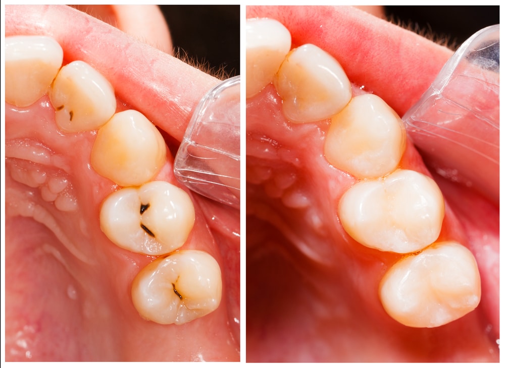Tooth Filling Vista