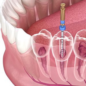 Endodontist Oceanside
