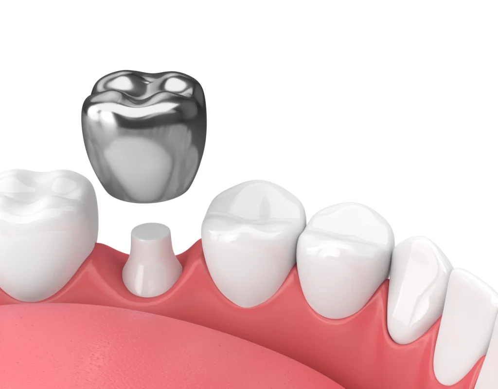 Dental Crown Oceanside