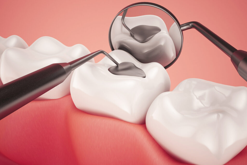 Tooth Filling Oceanside