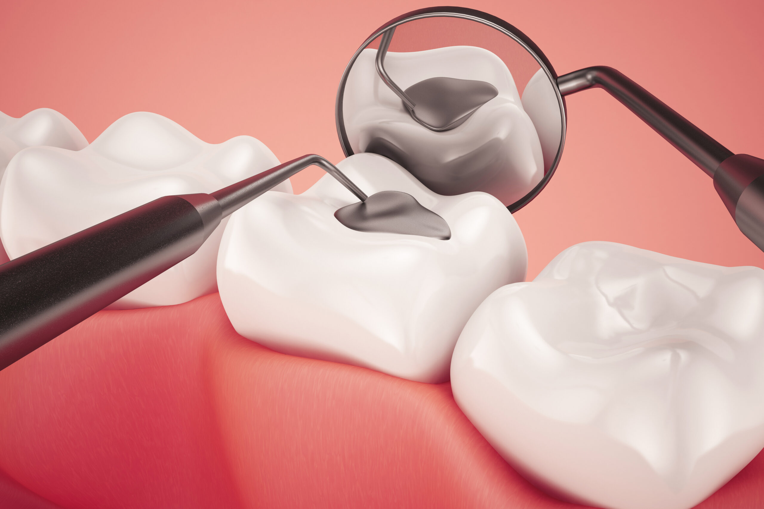 Tooth Filling Oceanside