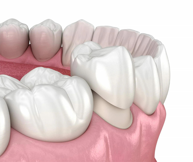 Dental Crown Carlsbad