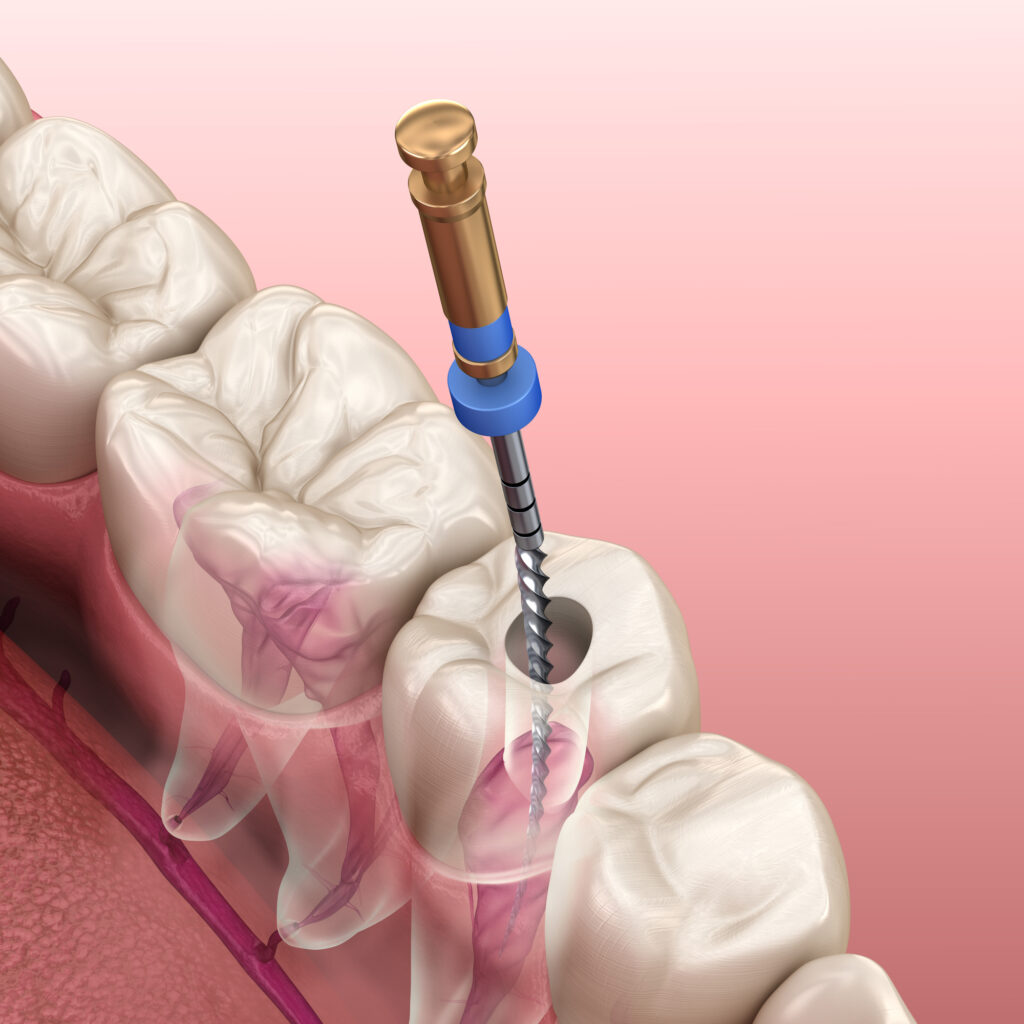 Vista Endodontist