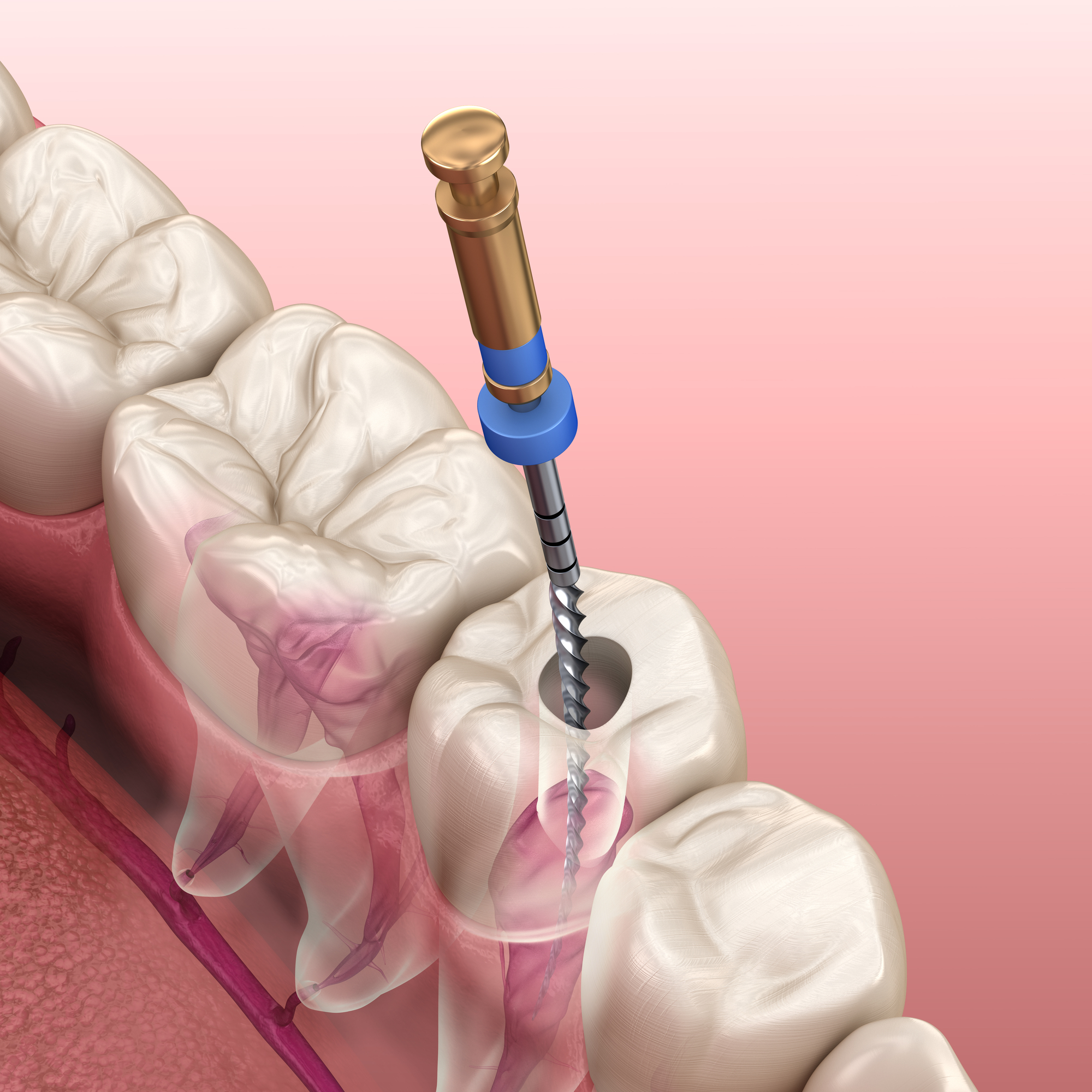 Vista Endodontist