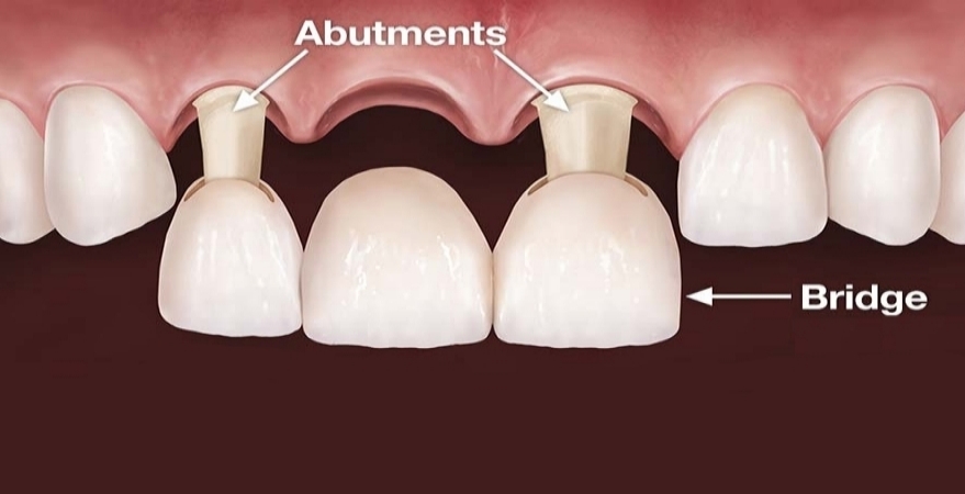 Dental Bridge Oceanside