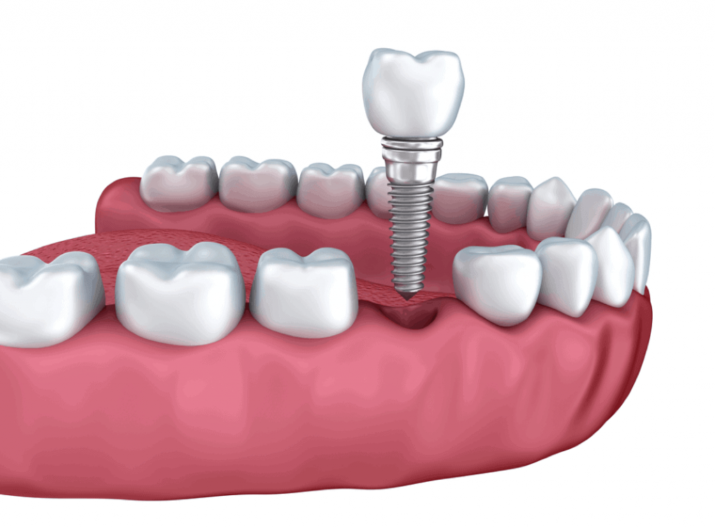 Dental Implant Cost Oceanside