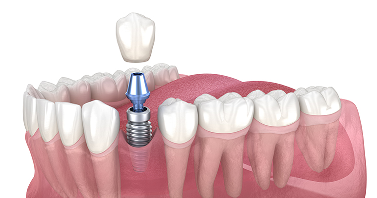Dental Implants Oceanside
