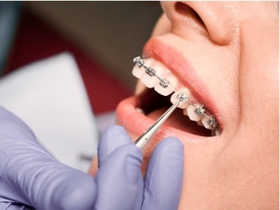 Carlsbad Orthodontist Near Me