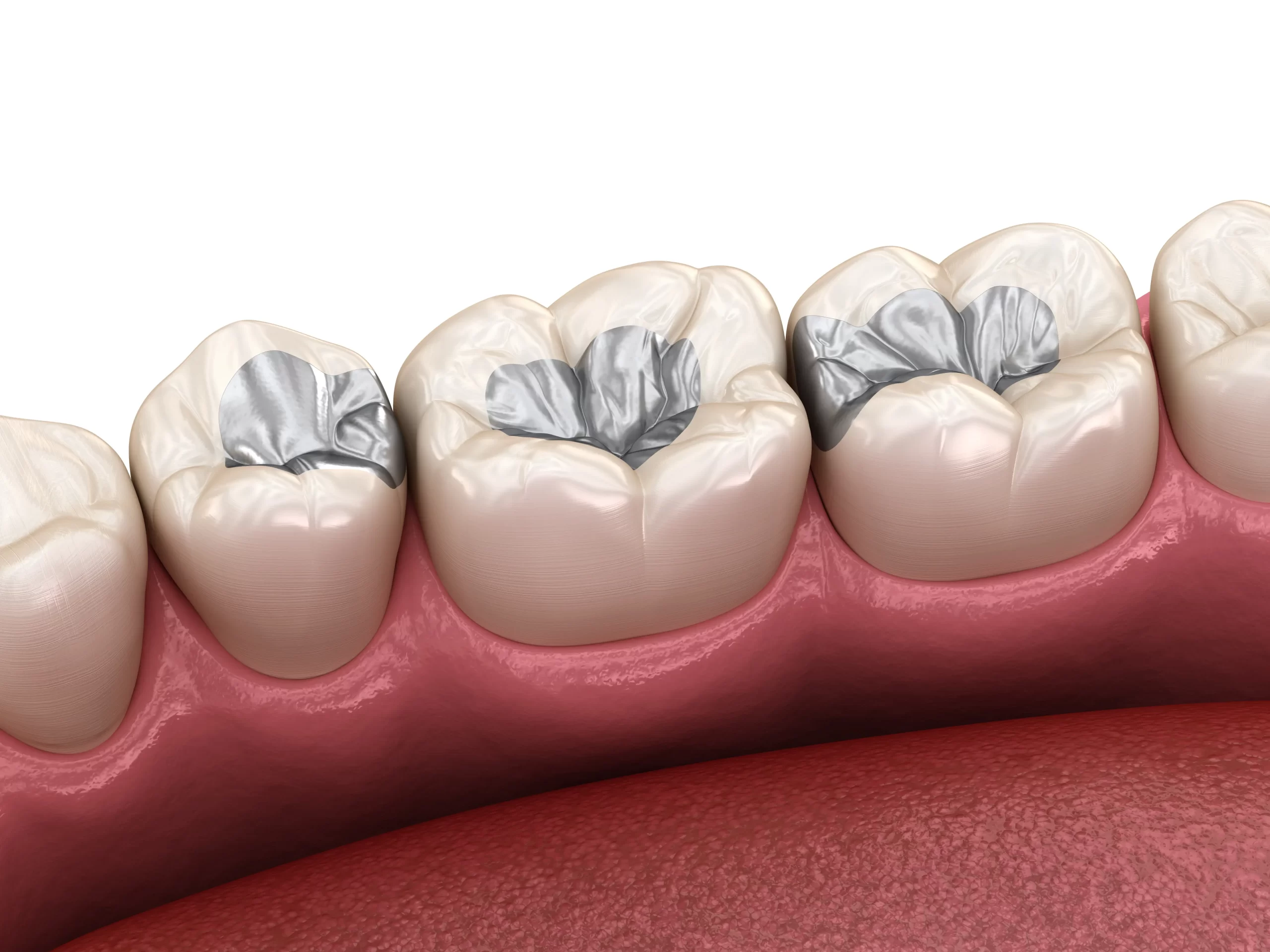 Tooth Filling Carlsbad