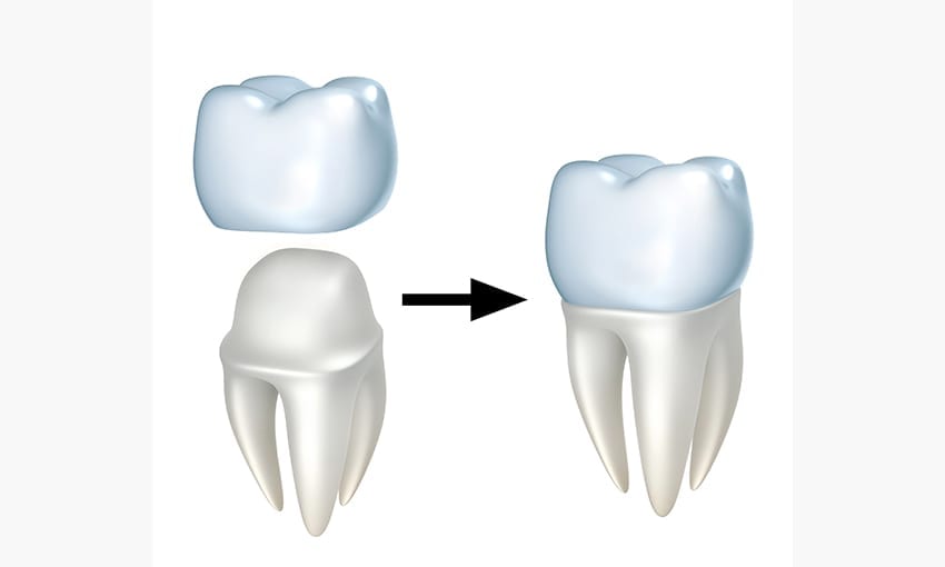 Dental Crown Oceanside