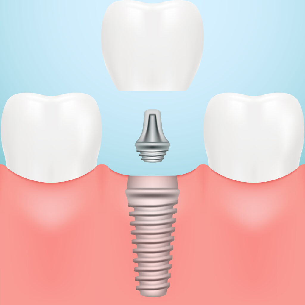 Dental Implants Near Me Carlsbad